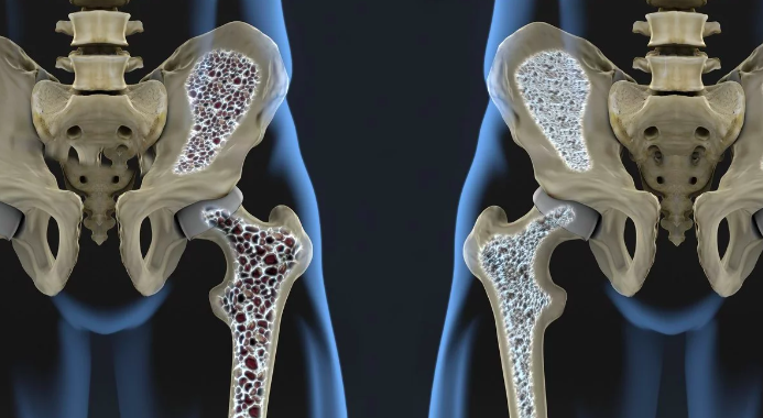 Cómo controlar el dolor de la osteoporosis crónica